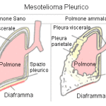 mesotelioma-pleurico (1)