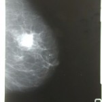 tumore-al-seno-breast-cancer