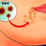 670px-Prevent-Cold-Sores-Step-1