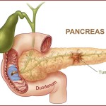 A-pancric-cancer-illustration