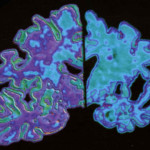 alzheimers (1)