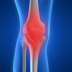 arthritis