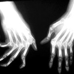 artrite