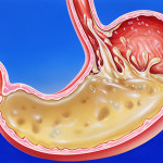 Stomach acid reflux