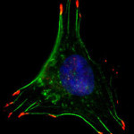 270660-breast-cancer-cell