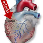 Herzinfarkt