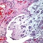 adult_cystic_fibrosis_bronchus