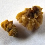 kidneystones-small
