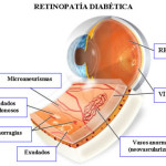 retinopatia-diabetica