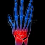 6003100-mano-umana-a-raggi-x--artrite