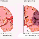 Ictus2-staminali