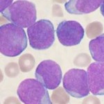 TYP-477120-Acute_leukemia-ALL