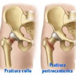 frattura_anca_3
