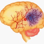 il-15-degli-ictus-in-eta-giovanile_8e3210e4-4629-11e3-8d61-e61b8e441f19_display