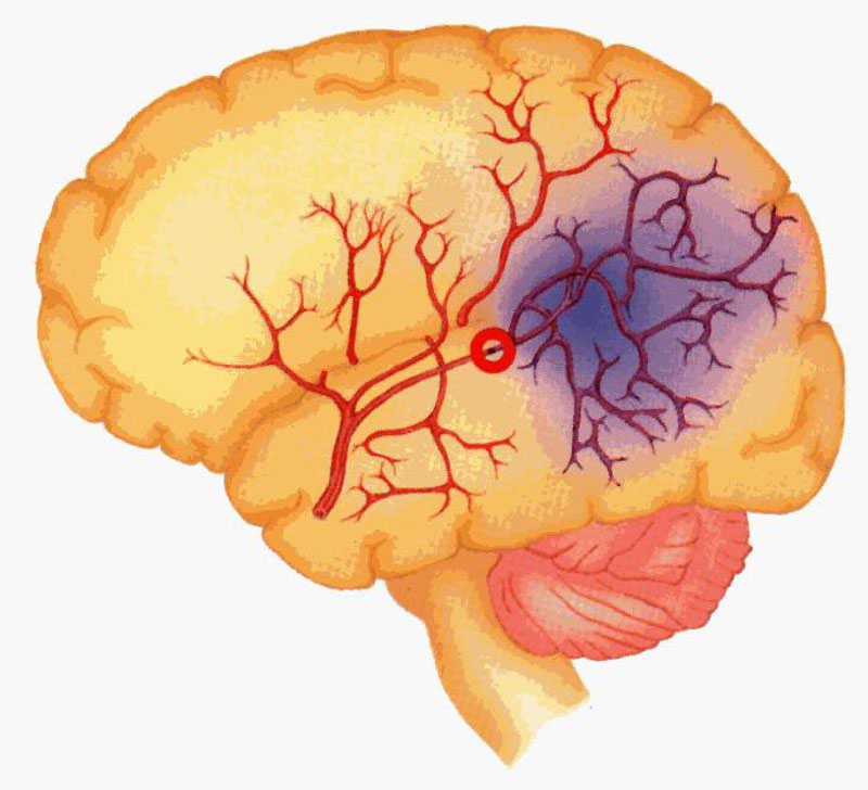 Ишемическая головного мозга новорожденного. Малый ишемический инсульт головного мозга. Геморрагический инсульт. Срез ткани мозга инсульт.