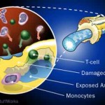 sclerosi_multipla (1)