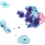 Herpes_simplex_virus_pap_test