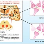 Morbo-di-Parkinson-origine-sintomi-cure