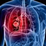 article_tumore_polmoni_20120404171103_0