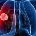 cancro_polmone_autoCut_664x230