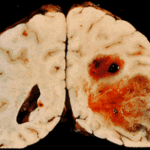 glioblastoma