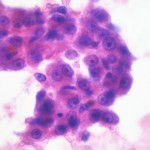 hepatocarcinomadiferenciado11