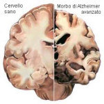 morbo-di-alzheimer