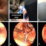 totally-endoscopic-aortic-valve-replacement