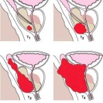 Tumore Prostatico stadio