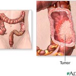 colon_cancer