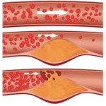 patologia_carotidea_1