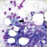 AnnIndianAcadNeurol_2013_16_2_279_112498_f2