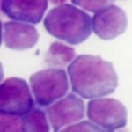 aml-cells