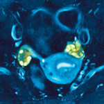 700_dettaglio2_ovaio-policistico