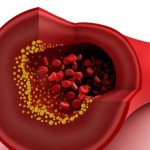 cholesterol-plaque-in-artery
