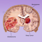 brain-tumor
