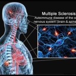 sclerosi_multipla