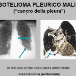 Mesotelioma2