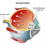OCCHIO-CON-GLAUCOMA