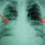 fibropre