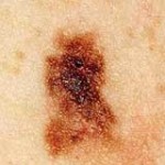 melanoma1