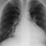 pulmonary_hypertension-590x393