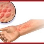 rash-orticaria