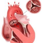 22958063_stenosi-della-valvola-aortica-cause-cure-0