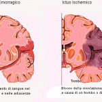Ictus2-staminali