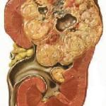 carcinoma renale