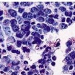 700_dettaglio2_Mieloma-multiplo