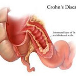 morbo-crohn