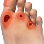 0a2dd1bb25a77d3e96367d5d38bd0f74piede_diabetico