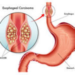 carcinoma-esofageo-43593514